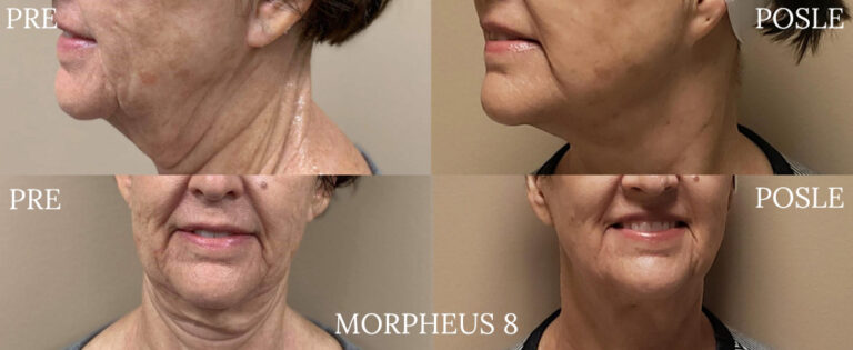 Morpheus 8 - Pre i posle