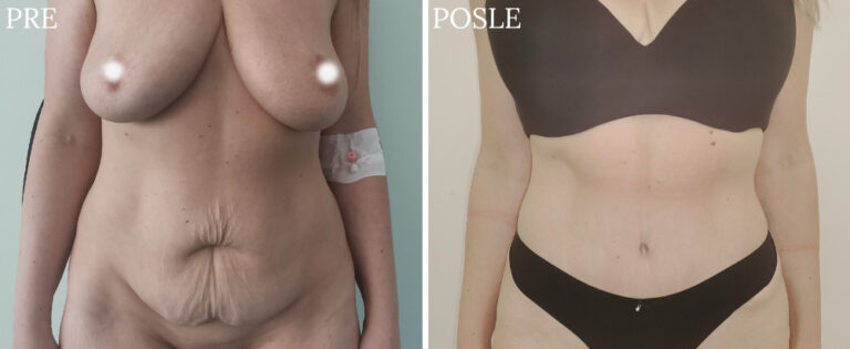 mommy makeover - Pre i posle