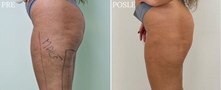 liposukcija - Pre i posle