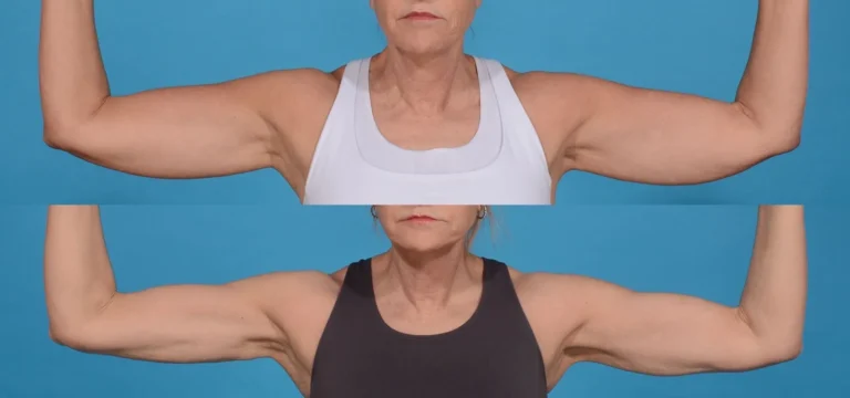 BodyTite kao rešenje za opuštenu kožu nadlaktica