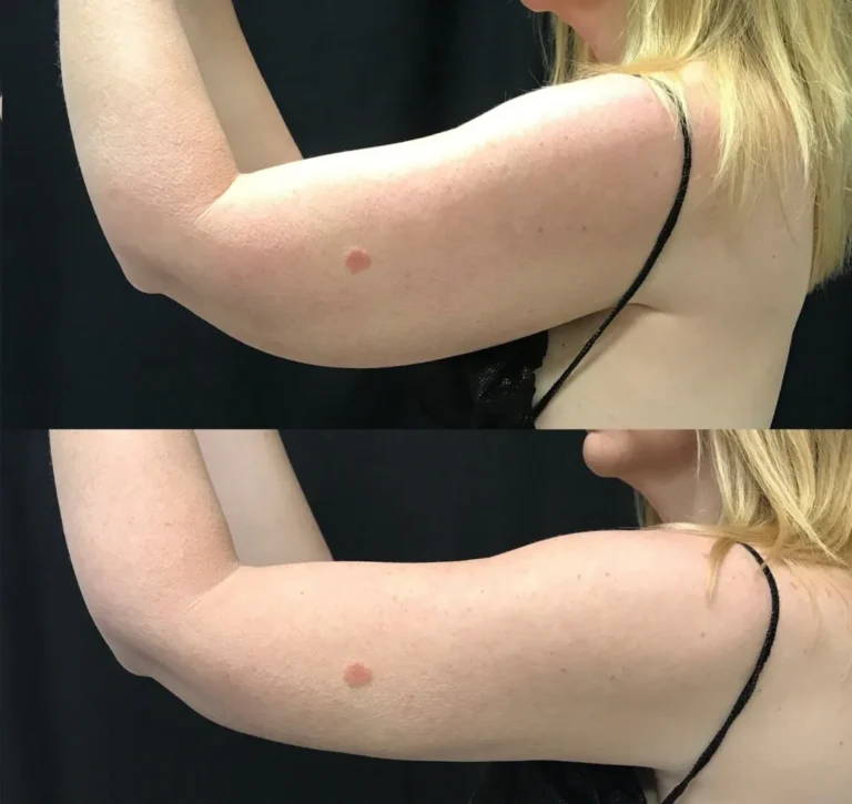 BodyTite kao rešenje za opuštenu kožu nadlaktica