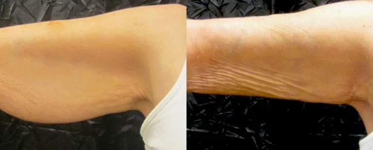 BodyTite kao rešenje za opuštenu kožu nadlaktica