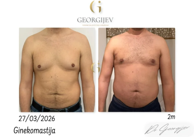 ginekomastija-1