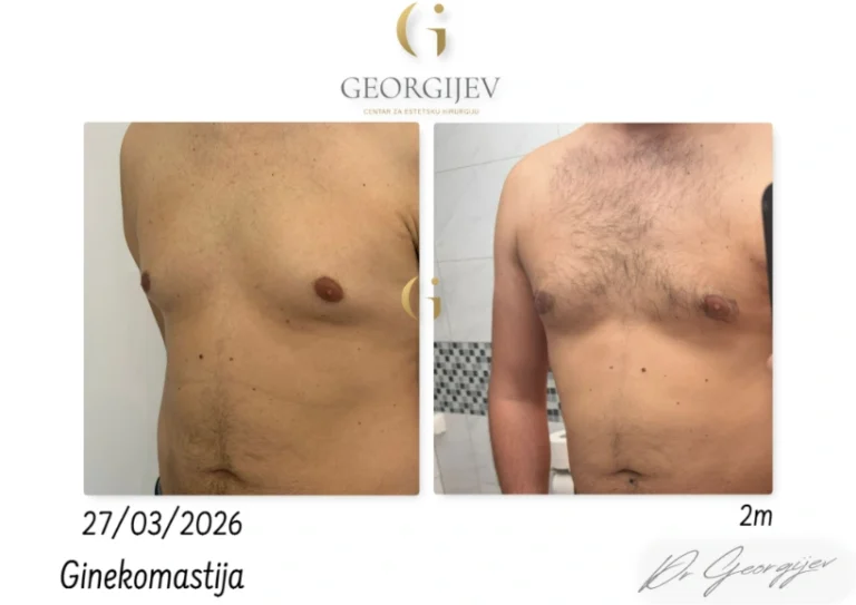 ginekomastija-10