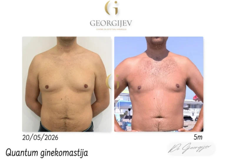 ginekomastija-11