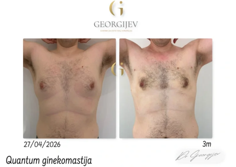 ginekomastija-12