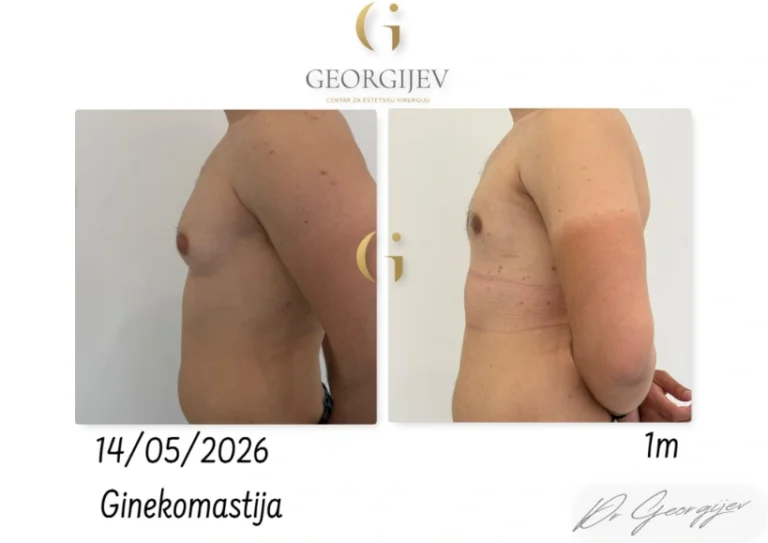 ginekomastija-13