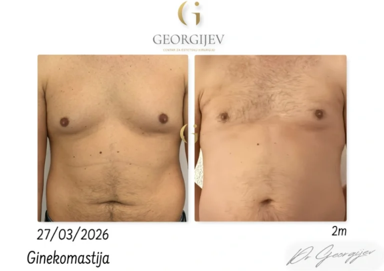 ginekomastija-14