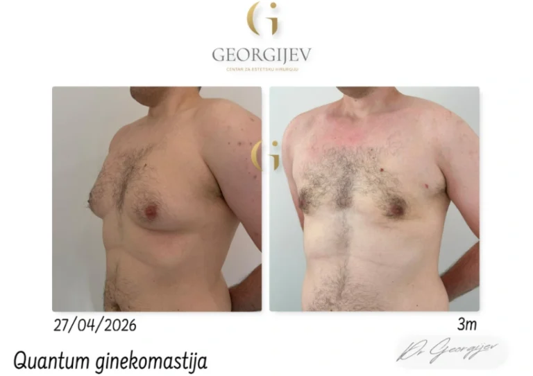 ginekomastija-15