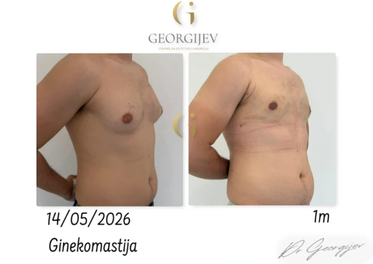 ginekomastija-16