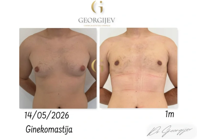 ginekomastija-2