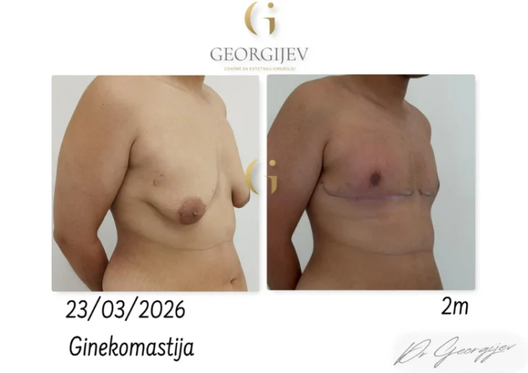 ginekomastija-3-1