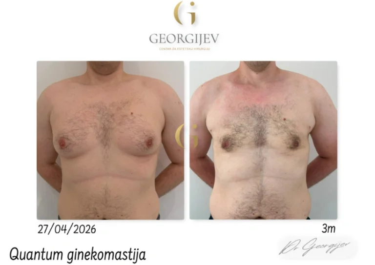 ginekomastija-3