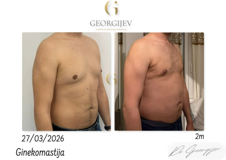 ginekomastija-4