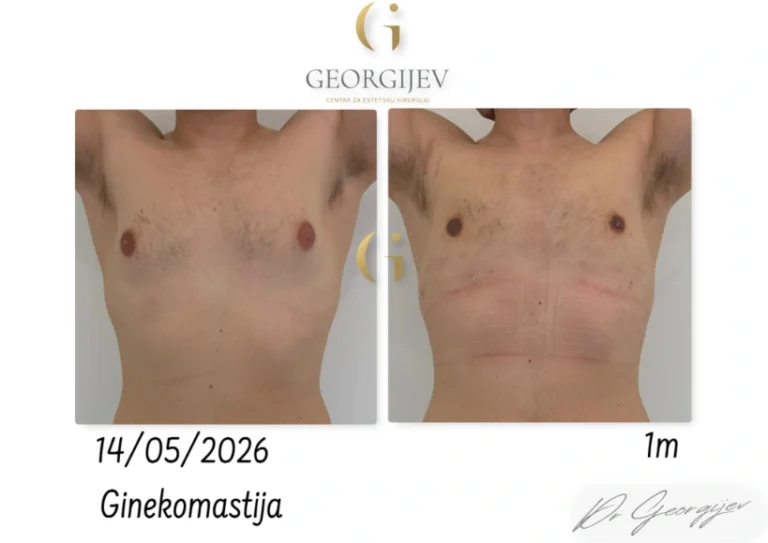 ginekomastija-5