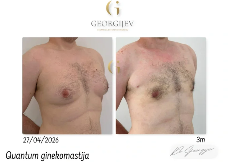 ginekomastija-6