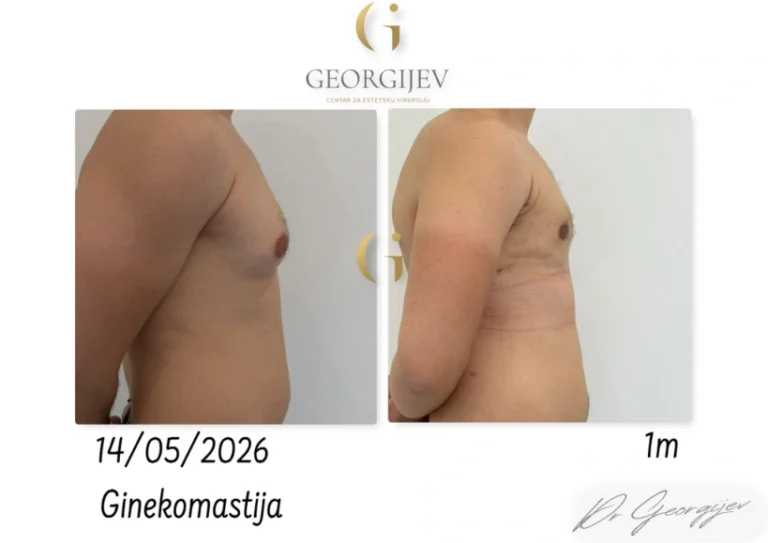 ginekomastija-7