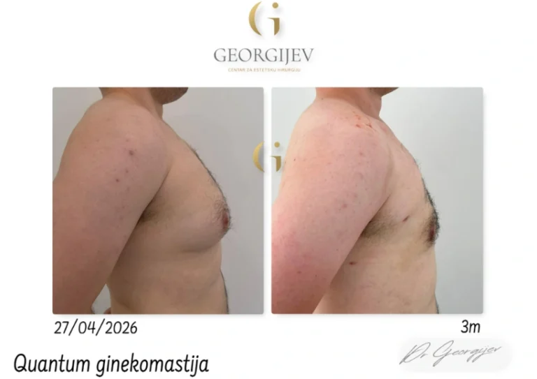 ginekomastija-8