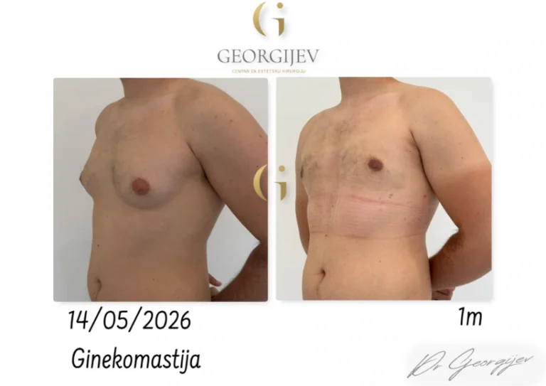 ginekomastija-9